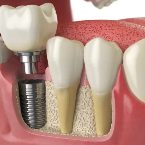 How Same-Day Implants Can Transform Your Smile